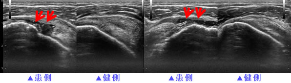 腱板断裂