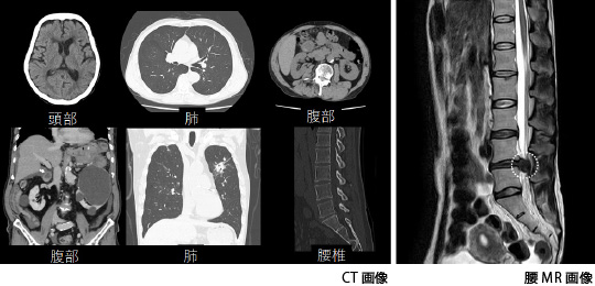 CT画像/腰MRI画像